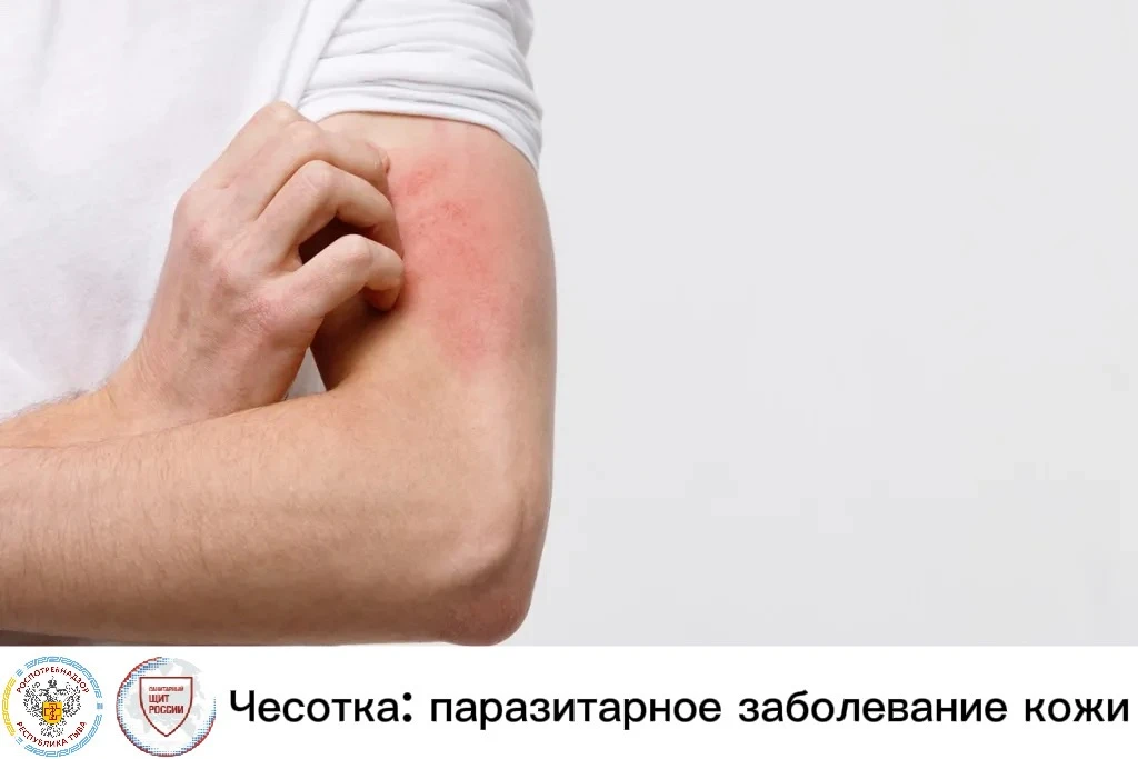 Чесотка – это кожное паразитарное заболевании, которое вызывается чесоточным клещом (Sarcoptes scabei)